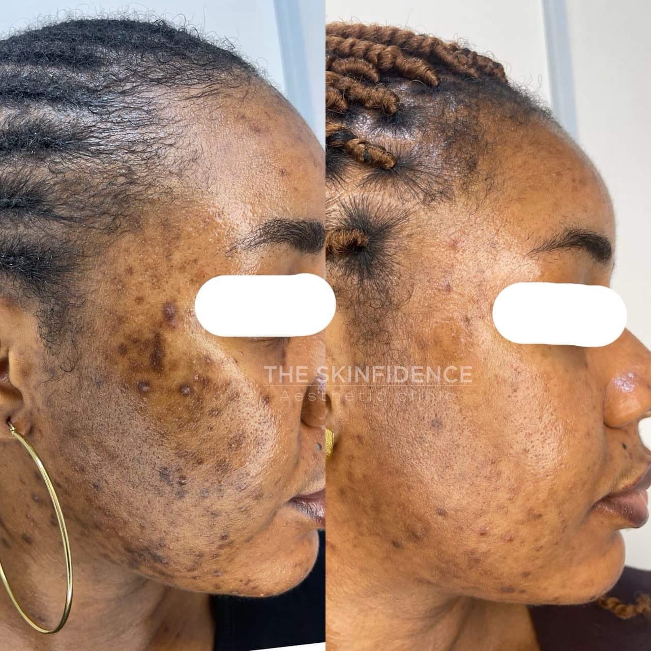 Advanced Skin Peeling