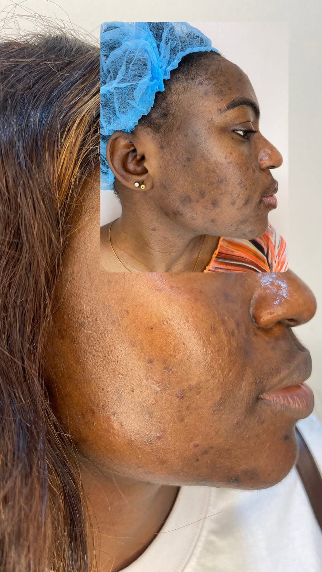 Advanced Skin Peeling