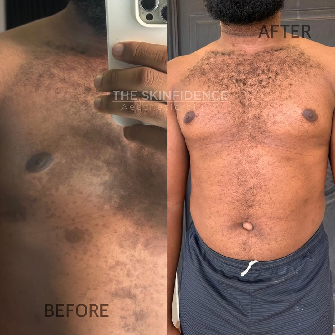 Mole & Skin Tag Removal
