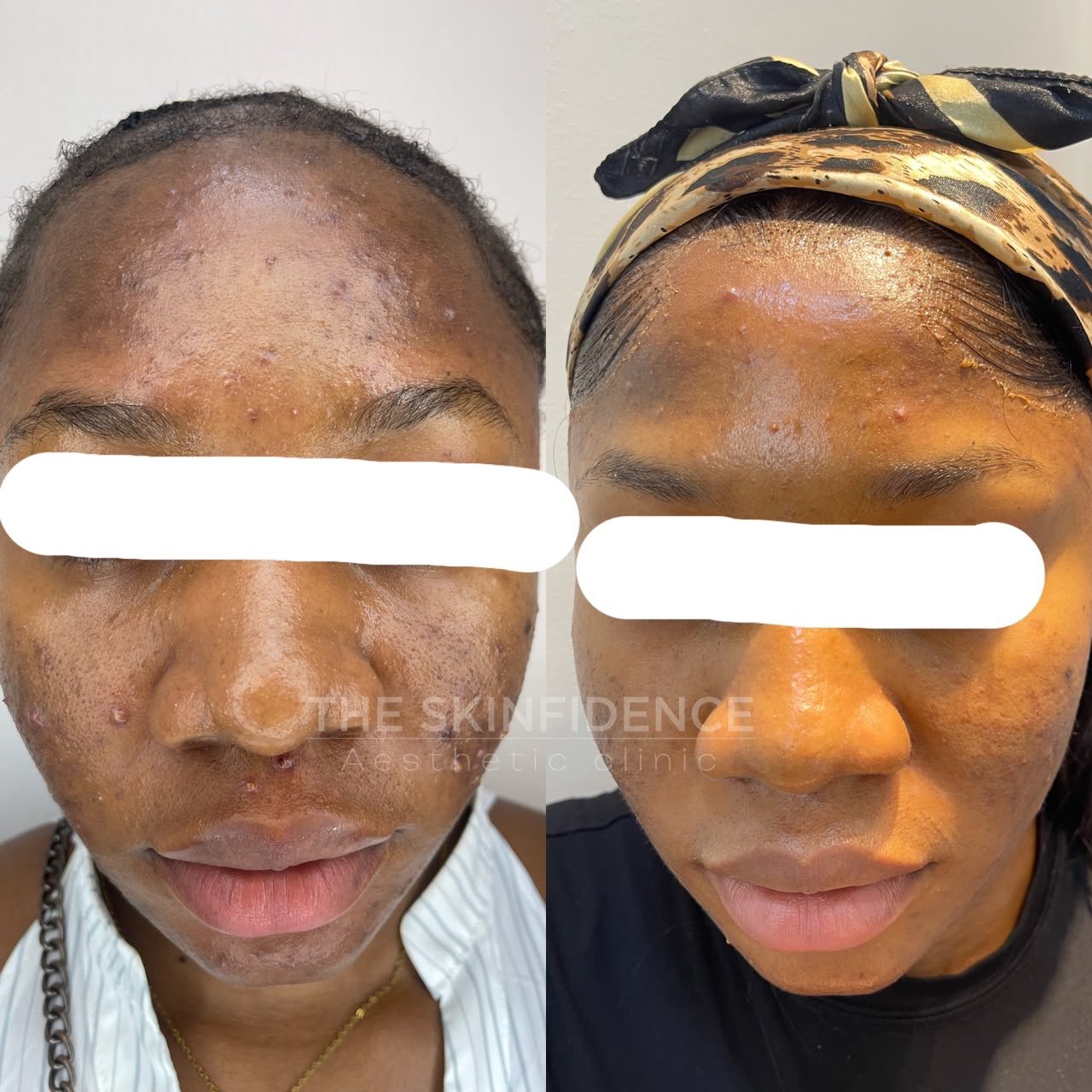Real Skinfidence client before and after an acne bootcamp
